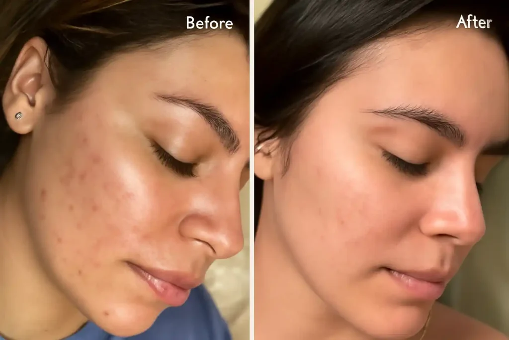 syleora clear pulse ultrasonic skin scrubber before after compare customer 1