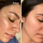 syleora clear pulse ultrasonic skin scrubber before after compare customer 1