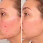 syleora clear pulse ultrasonic skin scrubber before after compare customer 6