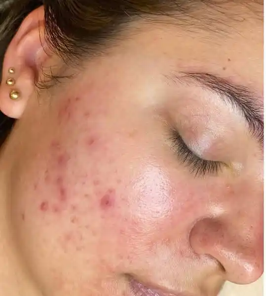 syleora skin care cleanpulse customer1 before using the device syleora skin care cleanpulse customer1 before using the device