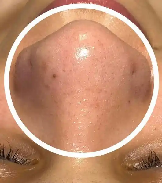 syleora skin care cleanpulse customer2 nose closeup shot after using the device syleora skin care cleanpulse customer2 nose closeup shot after using the device