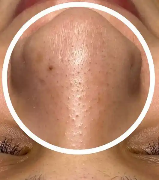 syleora skin care cleanpulse customer2 nose closeup shot before using the device syleora skin care cleanpulse customer2 nose closeup shot before using the device